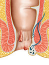 Simple yet Effective Hemorrhoid Home Treatment
